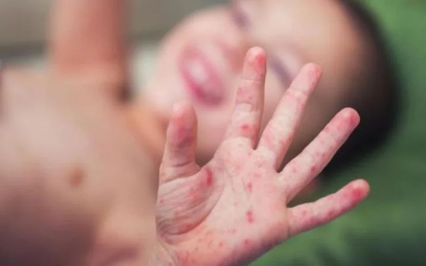 Qızılca epidemiyası yayıldı - Ölənlər var
