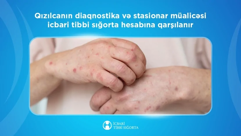 Bu xəstəlik də sığorta ilə müalicə olunacaq - DİQQƏT