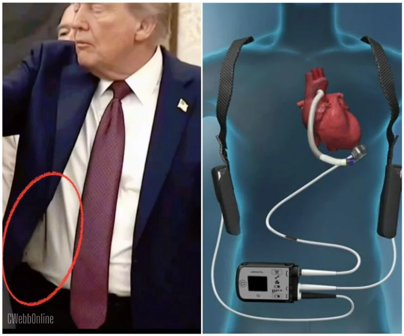 Trampın kostyumu altında nə var? LVAD taxması barədə şayiələr yayılıb