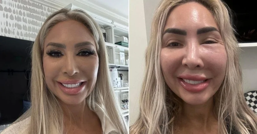 Model plastik əməliyyatdan sonra ağzını aça BİLMİR